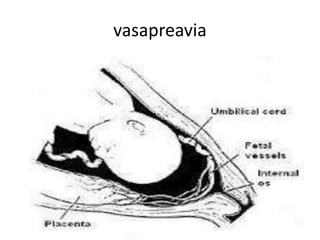 vasapreavia
 