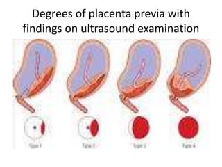 Degrees of placenta previa with
findings on ultrasound examination
 