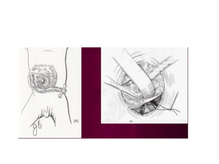 ANTERIOR ABDOMINAL WALL DEFECTS.pptx | Pregnancy | Reproductive Health