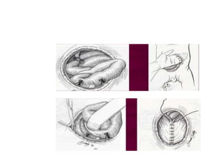 ANTERIOR ABDOMINAL WALL DEFECTS.pptx | Pregnancy | Reproductive Health