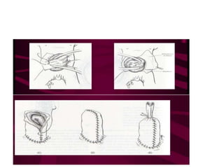 ANTERIOR ABDOMINAL WALL DEFECTS.pptx