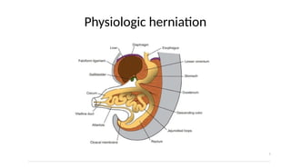 Physiologic herniation
 