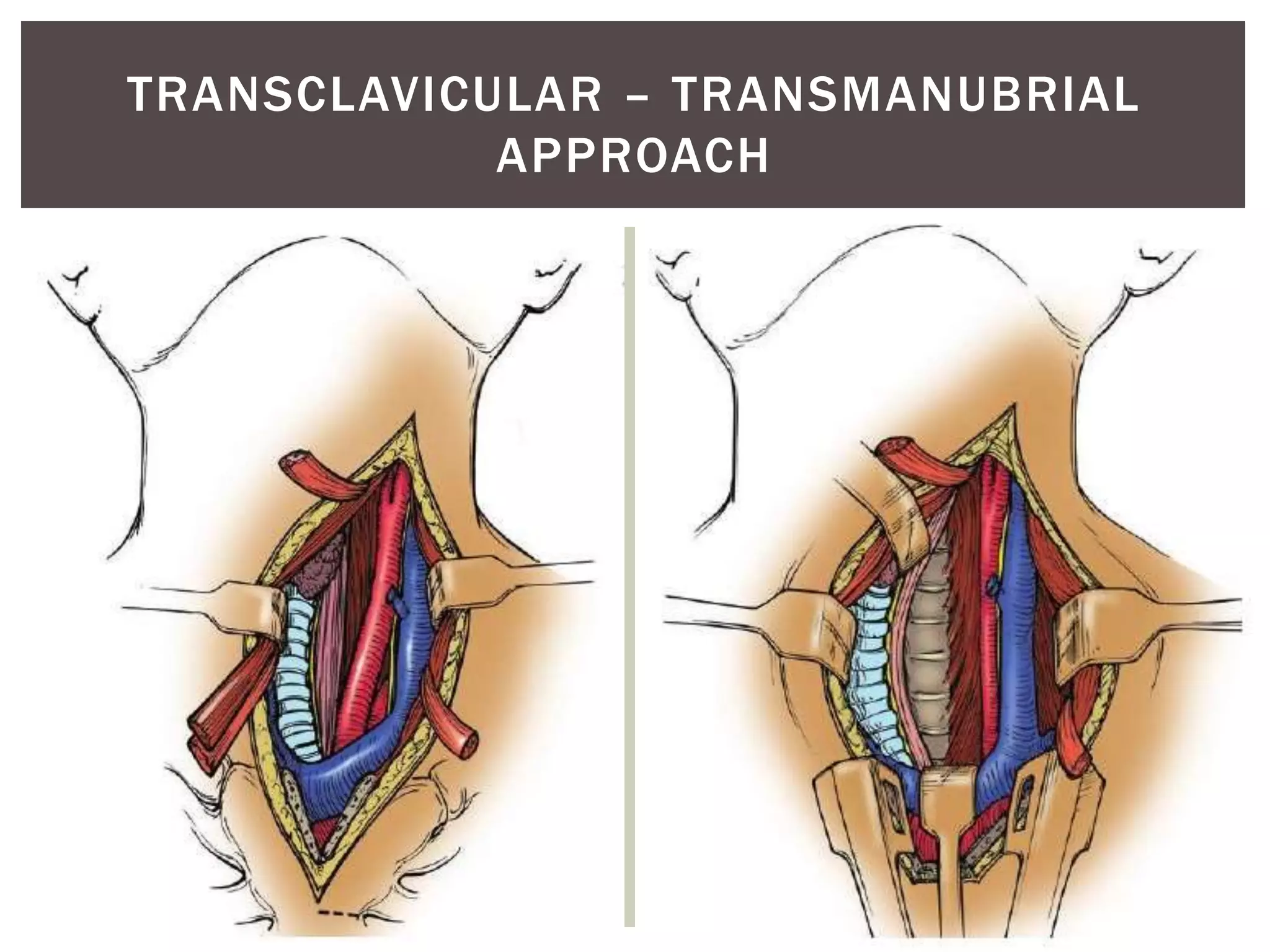 Thoracic Rfa Approach Anterior Approaches To The Thoracic Spine | PPTX