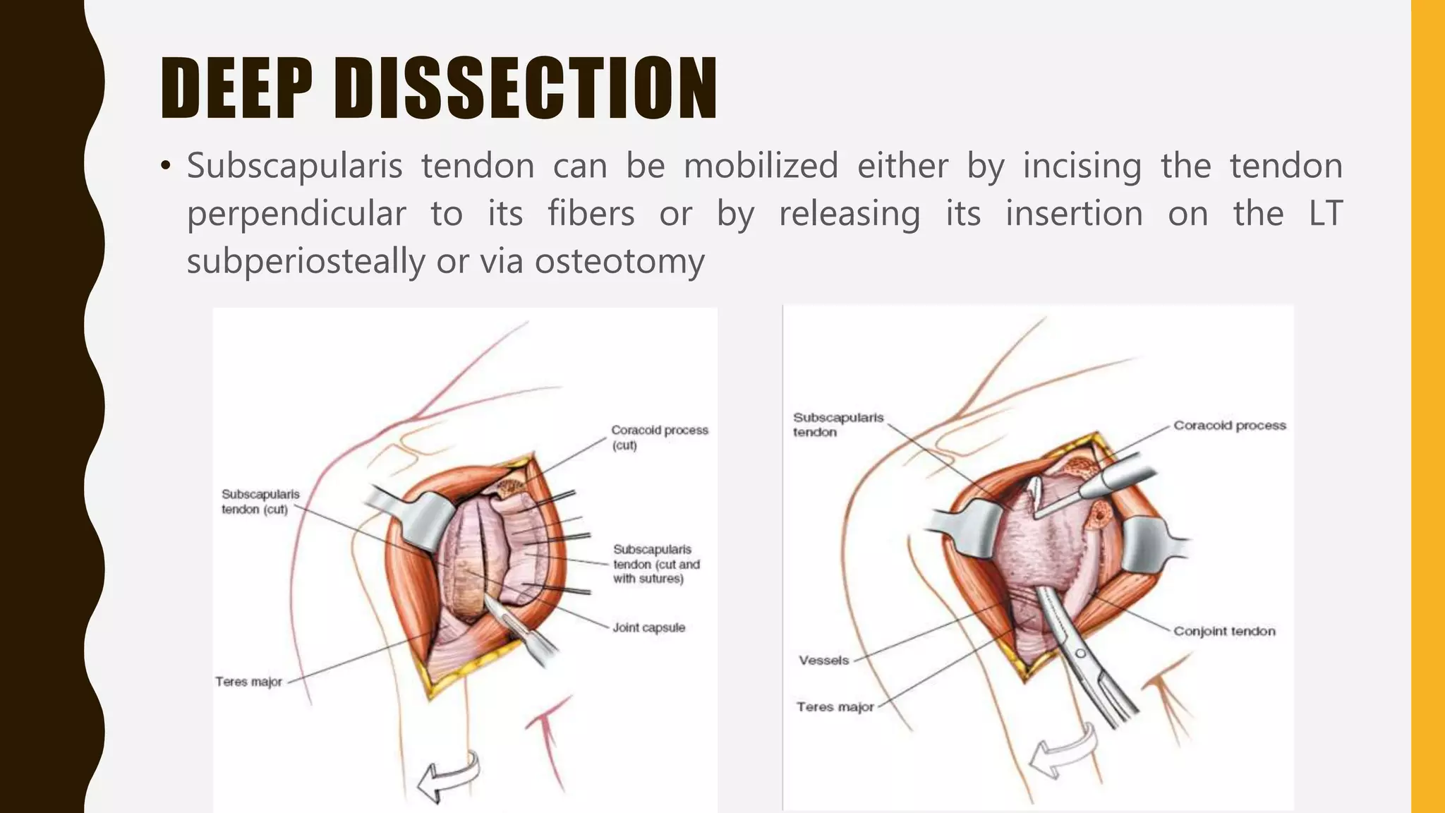 DEEP DISSECTION
• Subscapularis tendon can be mobilized either by incising the tendon
perpendicular to its fibers or by releasing its insertion on the LT
subperiosteally or via osteotomy
 