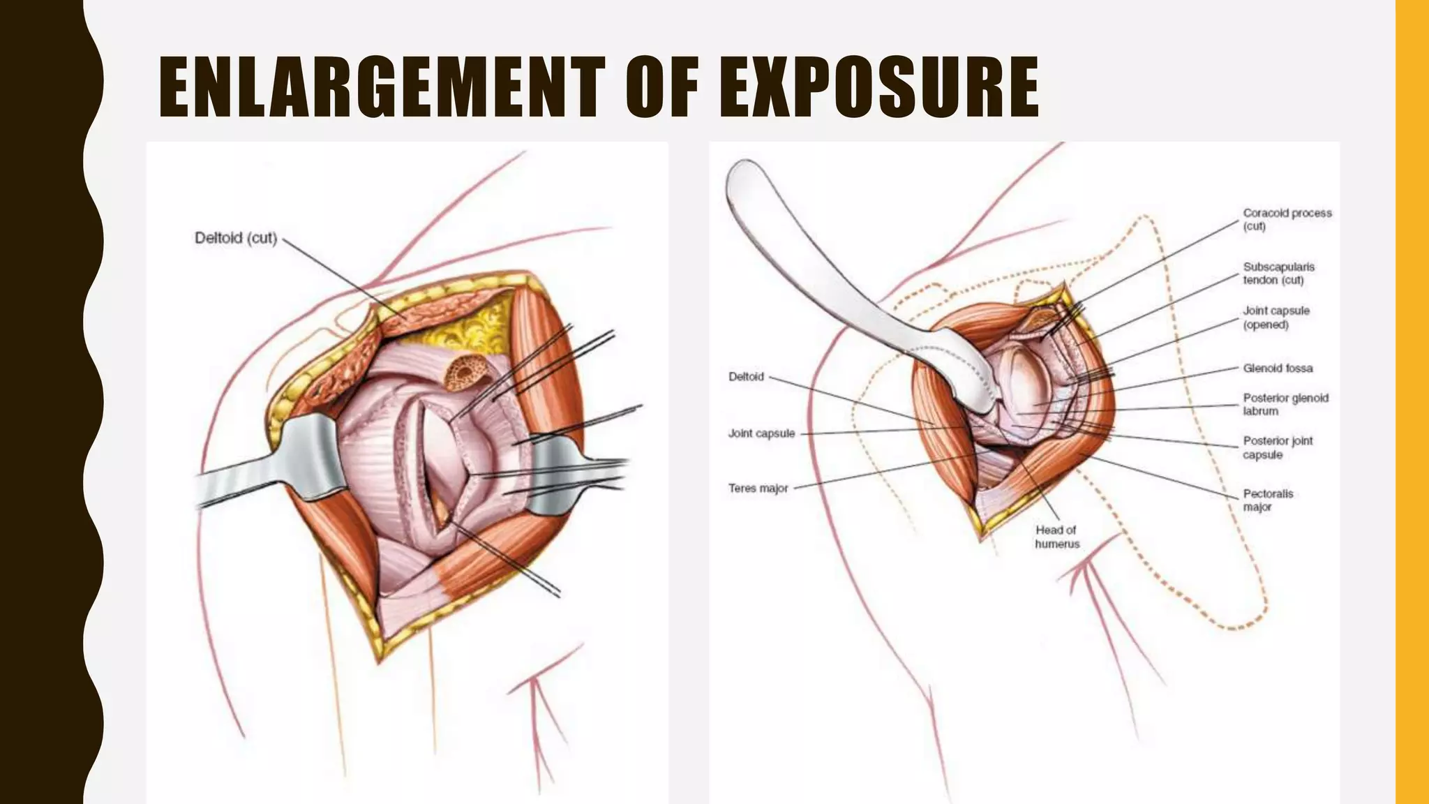 ENLARGEMENT OF EXPOSURE
 