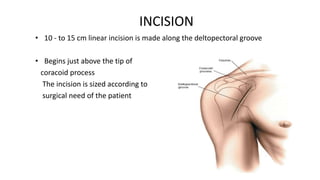 Incision Process Anterior approach to shoulder | PPTX