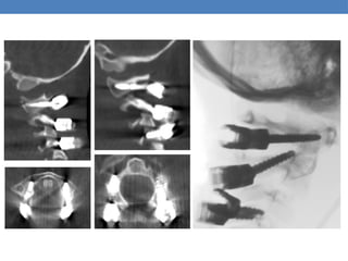 ANTERIOR CERVICAL INSTRUMENTATION (1).ppt