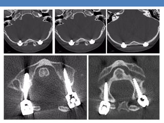 ANTERIOR CERVICAL INSTRUMENTATION (1).ppt