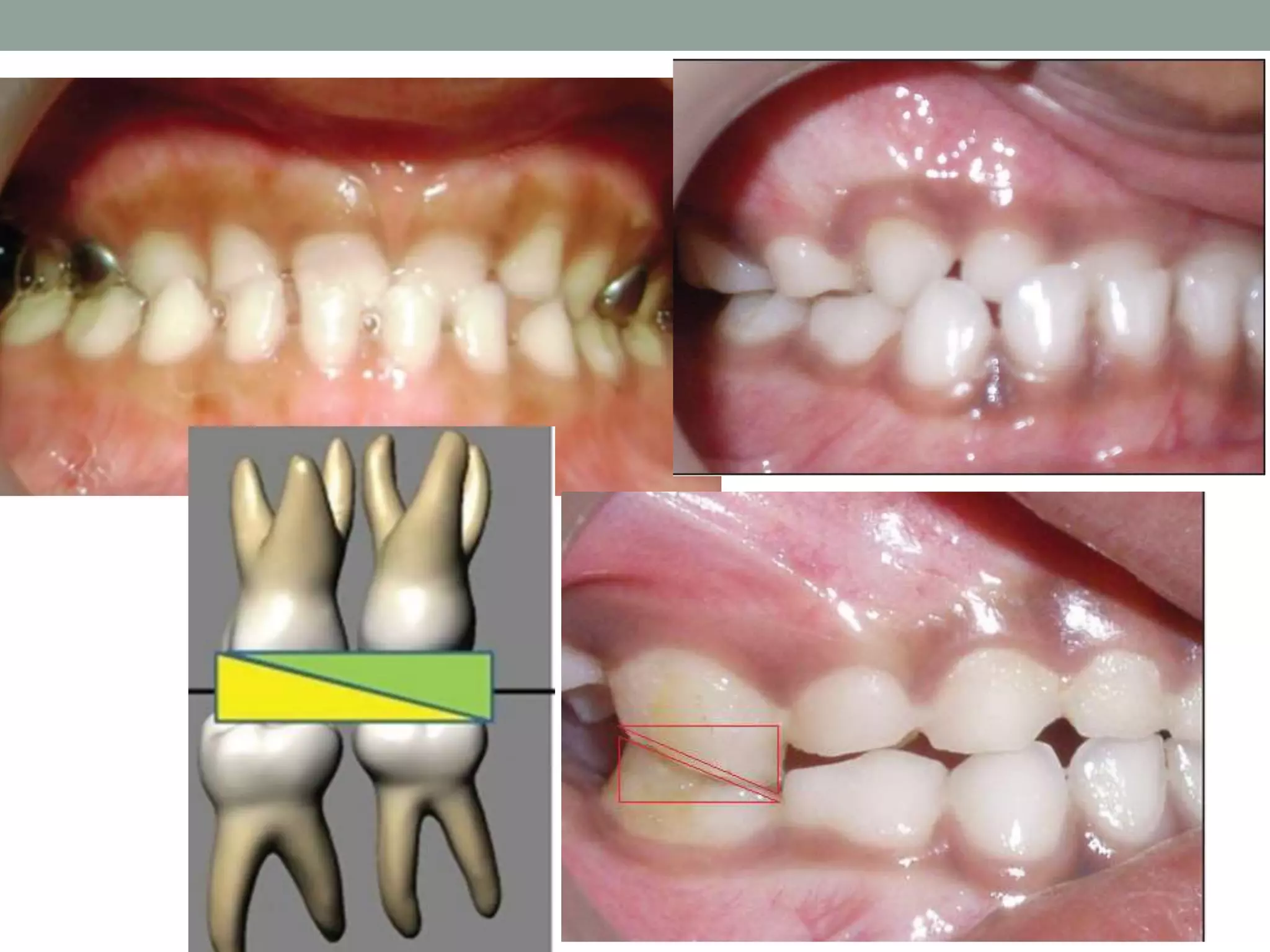 Cross Bitree Anterior crossbite | PPTX