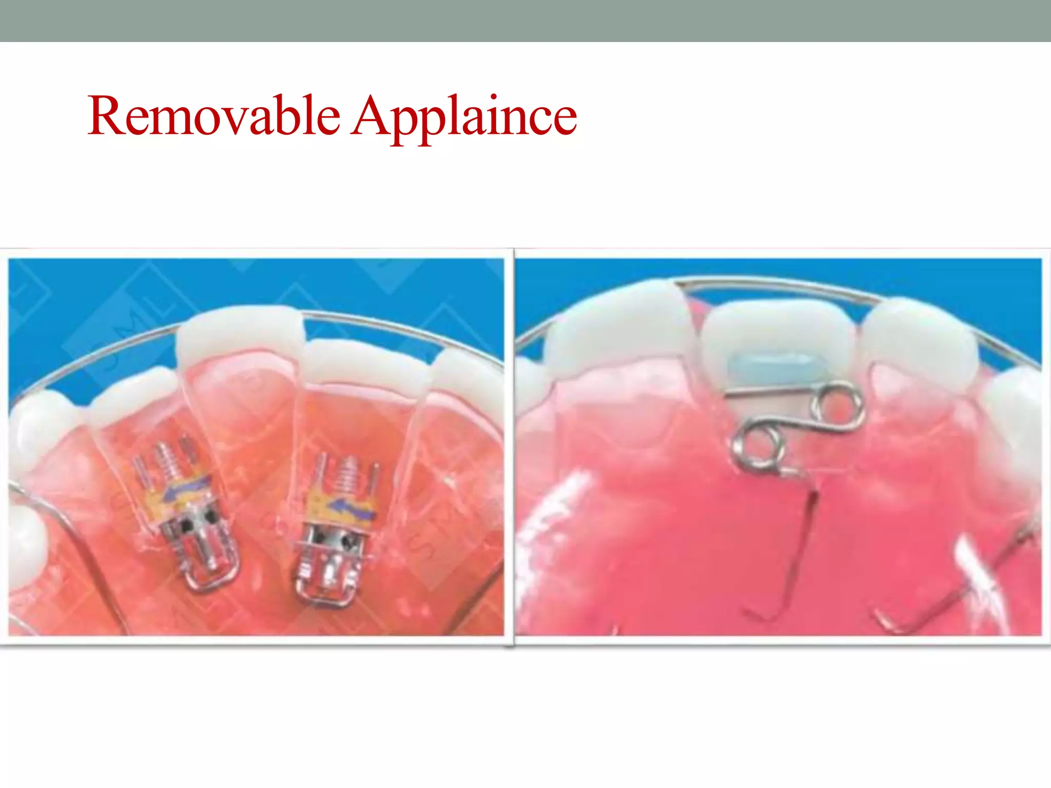 Crossbite Mask Anterior crossbite | PPTX