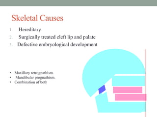 Skeletal Causes
1. Hereditary
2. Surgically treated cleft lip and palate
3. Defective embryological development
• Maxillary retrognathism.
• Mandibular prognathism.
• Combination of both
 
