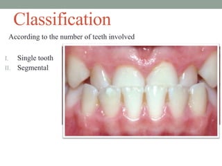 Classification
According to the number of teeth involved
I. Single tooth
II. Segmental
 