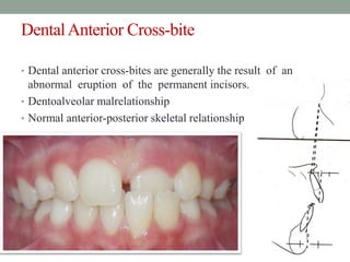 DentalAnterior Cross-bite
• Dental anterior cross-bites are generally the result of an
abnormal eruption of the permanent incisors.
• Dentoalveolar malrelationship
• Normal anterior-posterior skeletal relationship
 