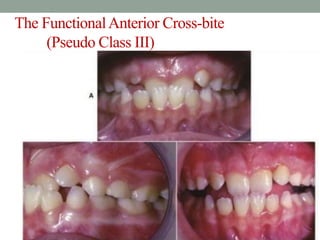 The FunctionalAnterior Cross-bite
(Pseudo Class III)
 