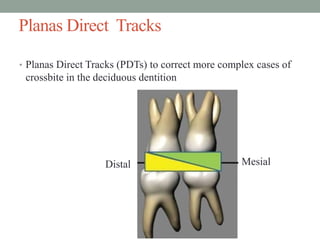 Planas Direct Tracks
• Planas Direct Tracks (PDTs) to correct more complex cases of
crossbite in the deciduous dentition
MesialDistal
 