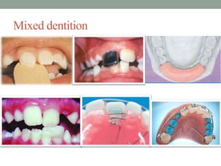 Mixed dentition
 