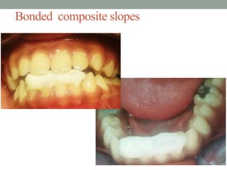 Bonded composite slopes
 