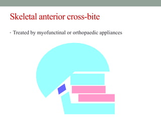 Skeletal anterior cross-bite
• Treated by myofunctinal or orthopaedic appliances
 