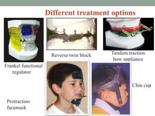 Different treatment options
Frankel functional
regulator
Tandem traction
bow appliance
Reverse twin block
Protraction
facemask
Chin cup
 