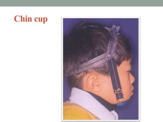 Chin cup
 