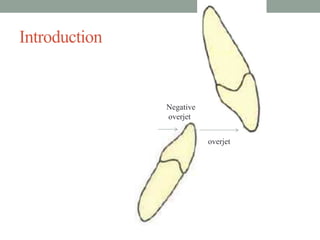 Introduction
overjet
Negative
overjet
 