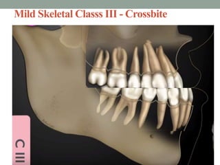 Mild Skeletal Classs III - Crossbite
 