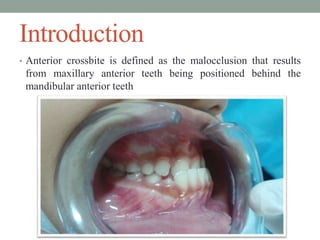 Introduction
• Anterior crossbite is defined as the malocclusion that results
from maxillary anterior teeth being positioned behind the
mandibular anterior teeth
 