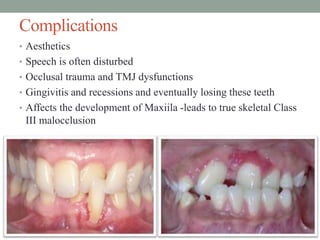 Complications
• Aesthetics
• Speech is often disturbed
• Occlusal trauma and TMJ dysfunctions
• Gingivitis and recessions and eventually losing these teeth
• Affects the development of Maxiila -leads to true skeletal Class
III malocclusion
 