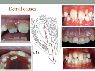 Dental causes
 
