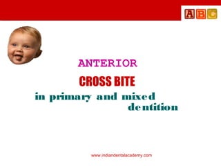 ANTERIOR
CROSS BITE
in primary and mixe d
de ntition

www.indiandentalacademy.com

 