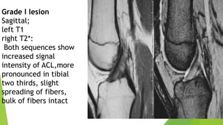 Anterior cruciate injuries and management (2).pptx