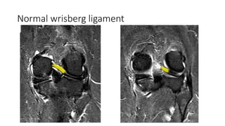 Anterior Cruciate Ligament.pptx