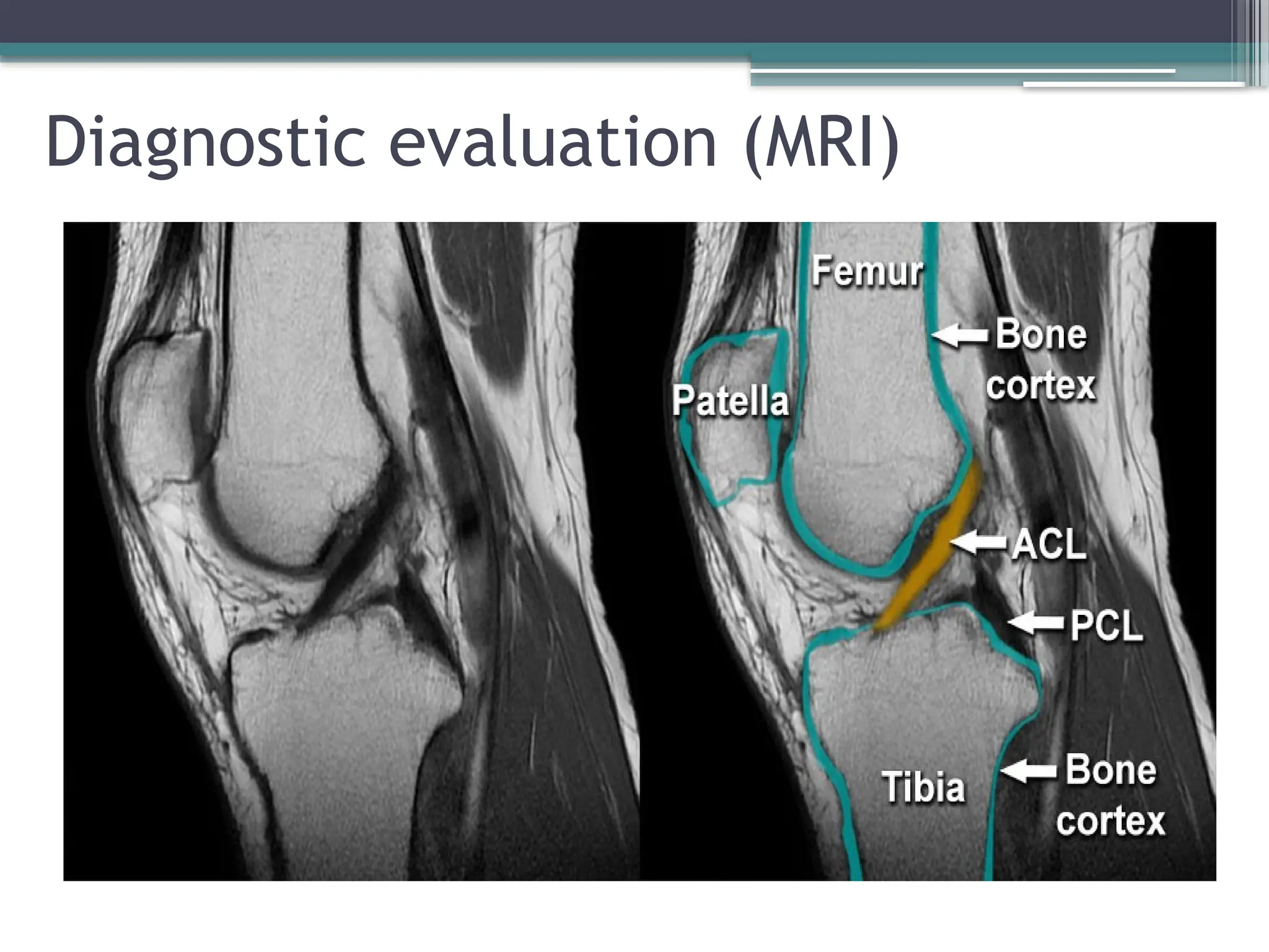 Anterior Cruciate Ligament Injuries.pptx