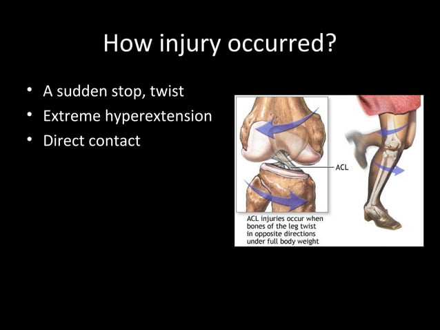 Anterior Cruciate ligament Injury | PPT