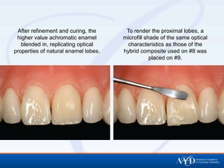 After refinement and curing, the      To render the proximal lobes, a
 higher value achromatic enamel       microfill shade of the same optical
   blended in, replicating optical     characteristics as those of the
properties of natural enamel lobes.   hybrid composite used on #8 was
                                                  placed on #9.
 