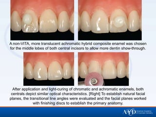 A non-VITA, more translucent achromatic hybrid composite enamel was chosen
for the middle lobes of both central incisors to allow more dentin show-through.




  After application and light-curing of chromatic and achromatic enamels, both
 centrals depict similar optical characteristics. [Right] To establish natural facial
planes, the transitional line angles were evaluated and the facial planes worked
              with finishing discs to establish the primary anatomy.
 