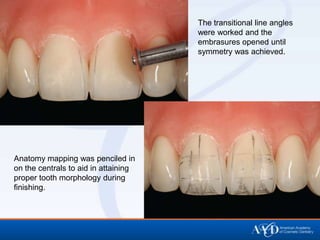 The transitional line angles
                                      were worked and the
                                      embrasures opened until
                                      symmetry was achieved.




Anatomy mapping was penciled in
on the centrals to aid in attaining
proper tooth morphology during
finishing.
 
