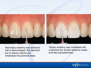 Secondary anatomy was achieved      Tertiary anatomy was completed with
with a flame-shaped, fine diamond   a diamond bur at slow speed to create
bur to reduce volume and            arch-like horizontal lines.
emphasize the proximal lobes.
 
