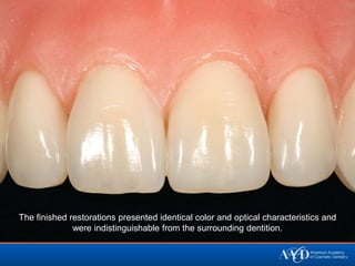 The finished restorations presented identical color and optical characteristics and
              were indistinguishable from the surrounding dentition.
 