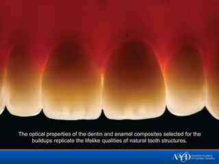 The optical properties of the dentin and enamel composites selected for the
     buildups replicate the lifelike qualities of natural tooth structures.
 