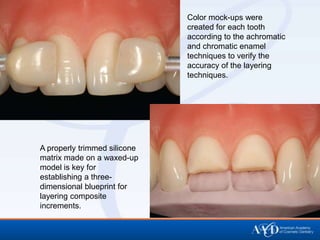 Color mock-ups were
                              created for each tooth
                              according to the achromatic
                              and chromatic enamel
                              techniques to verify the
                              accuracy of the layering
                              techniques.




A properly trimmed silicone
matrix made on a waxed-up
model is key for
establishing a three-
dimensional blueprint for
layering composite
increments.
 