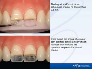 The lingual shelf must be an
achromatic enamel no thicker than
0.3 mm.




Once cured, the lingual shelves of
both centrals denote amber-whitish
nuances that replicate the
opalescence present in natural
enamel.
 