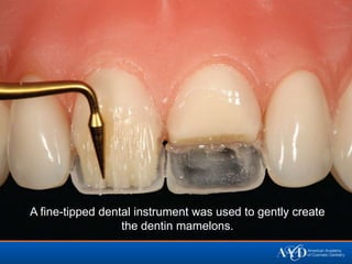 A fine-tipped dental instrument was used to gently create
                  the dentin mamelons.
 