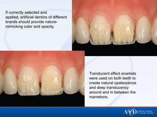 If correctly selected and
applied, artificial dentins of different
brands should provide nature-
mimicking color and opacity.




                                           Translucent effect enamels
                                           were used on both teeth to
                                           create natural opalescence
                                           and deep translucency
                                           around and in between the
                                           mamelons.
 
