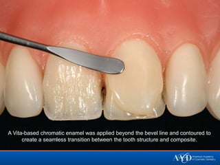 A Vita-based chromatic enamel was applied beyond the bevel line and contoured to
      create a seamless transition between the tooth structure and composite.
 