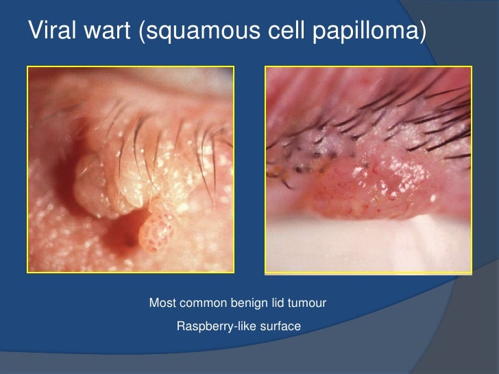 Anterior eye structures disorders