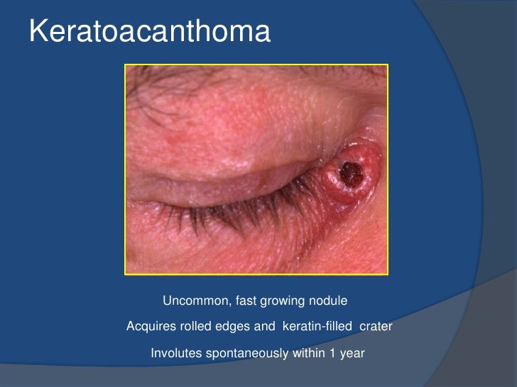 Anterior eye structures disorders