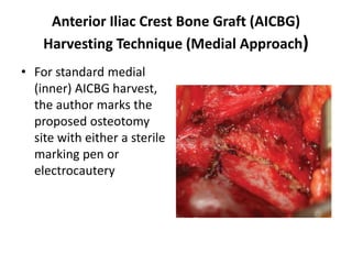 File:Anterior iliac crest graft location.png - Wikipedia