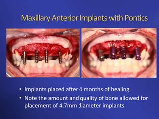 Anterior implants building the foundation | PPTX