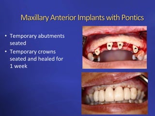 Anterior implants building the foundation | PPTX